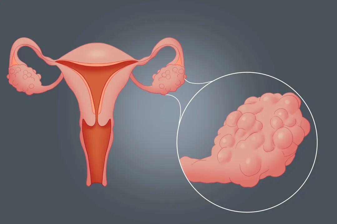 多囊卵巢综合征